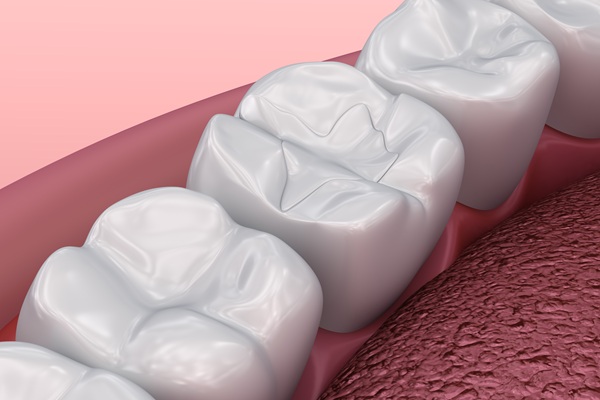 Does A Tooth Filling Last Forever?